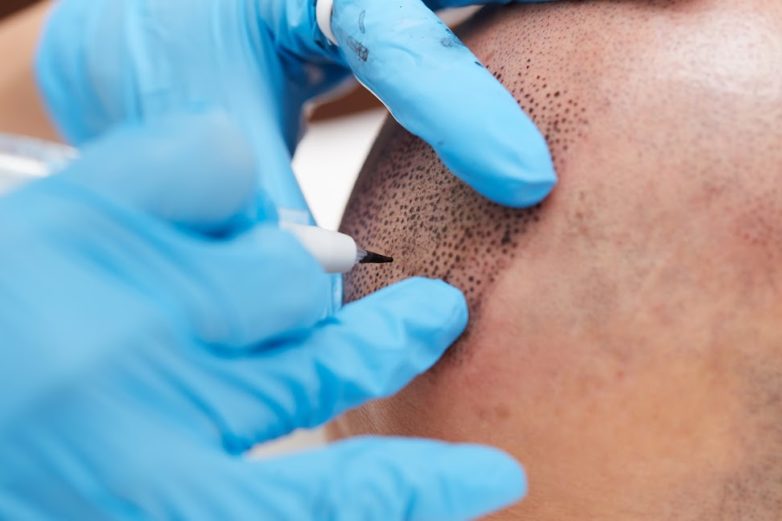 Hair Transplant Surgeon